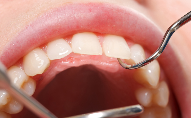 advanced-gum-treatment