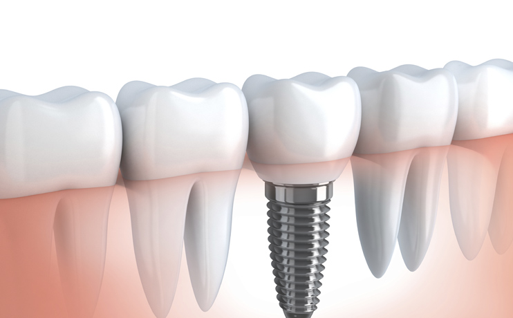 root-canals