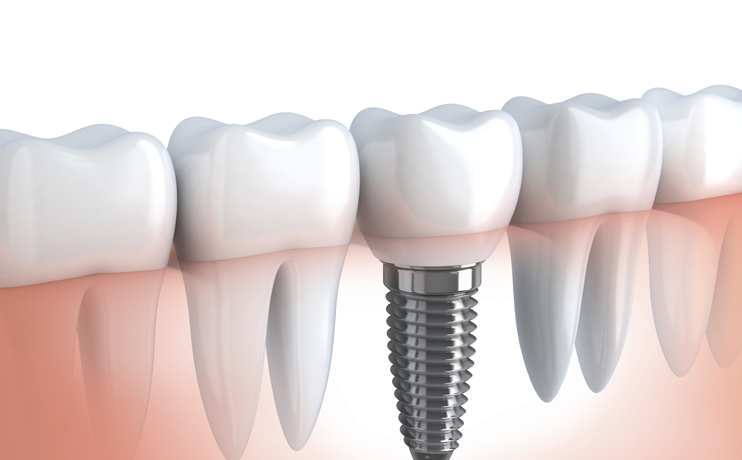 Root Canals