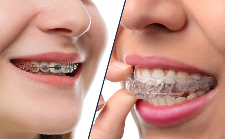 teeth-whitening